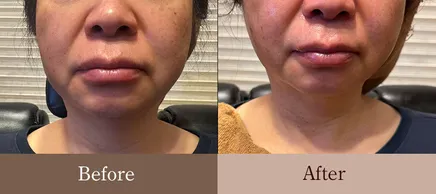 50代女性 正面 Before/After