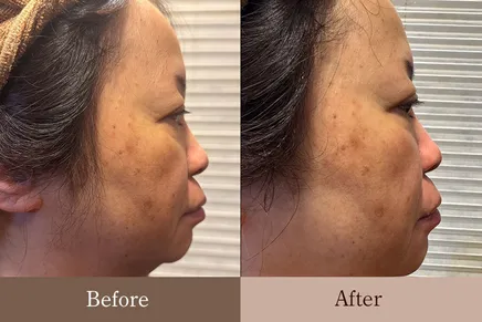 50代女性 横顔① Before/After