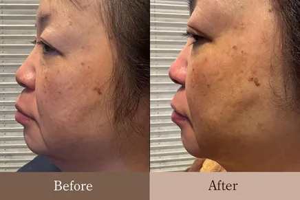 50代女性 横顔② Before/After