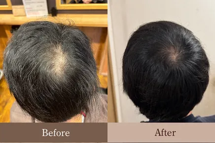 髪と頭皮のリバースエイジング Before/After