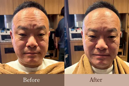 50代男性 お顔のリバースエイジング Before/After