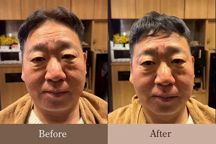 50代男性 お顔のリバースエイジング Before/After