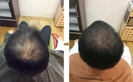 リバースエイジング